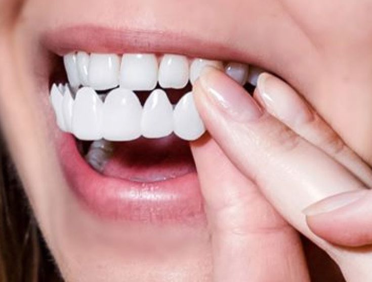 IMPORTED Snap-On Teeth Veneers